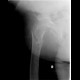 Pertrochanteric fracture, hardware migration, non-union: X-ray - Plain radiograph